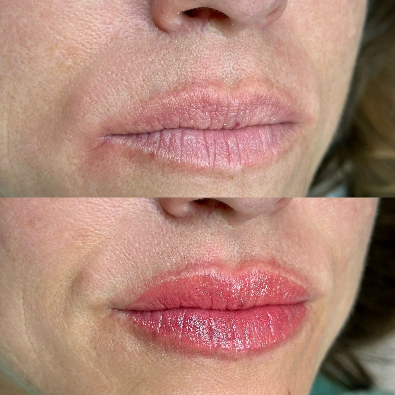 Revitalização labial — foto 2