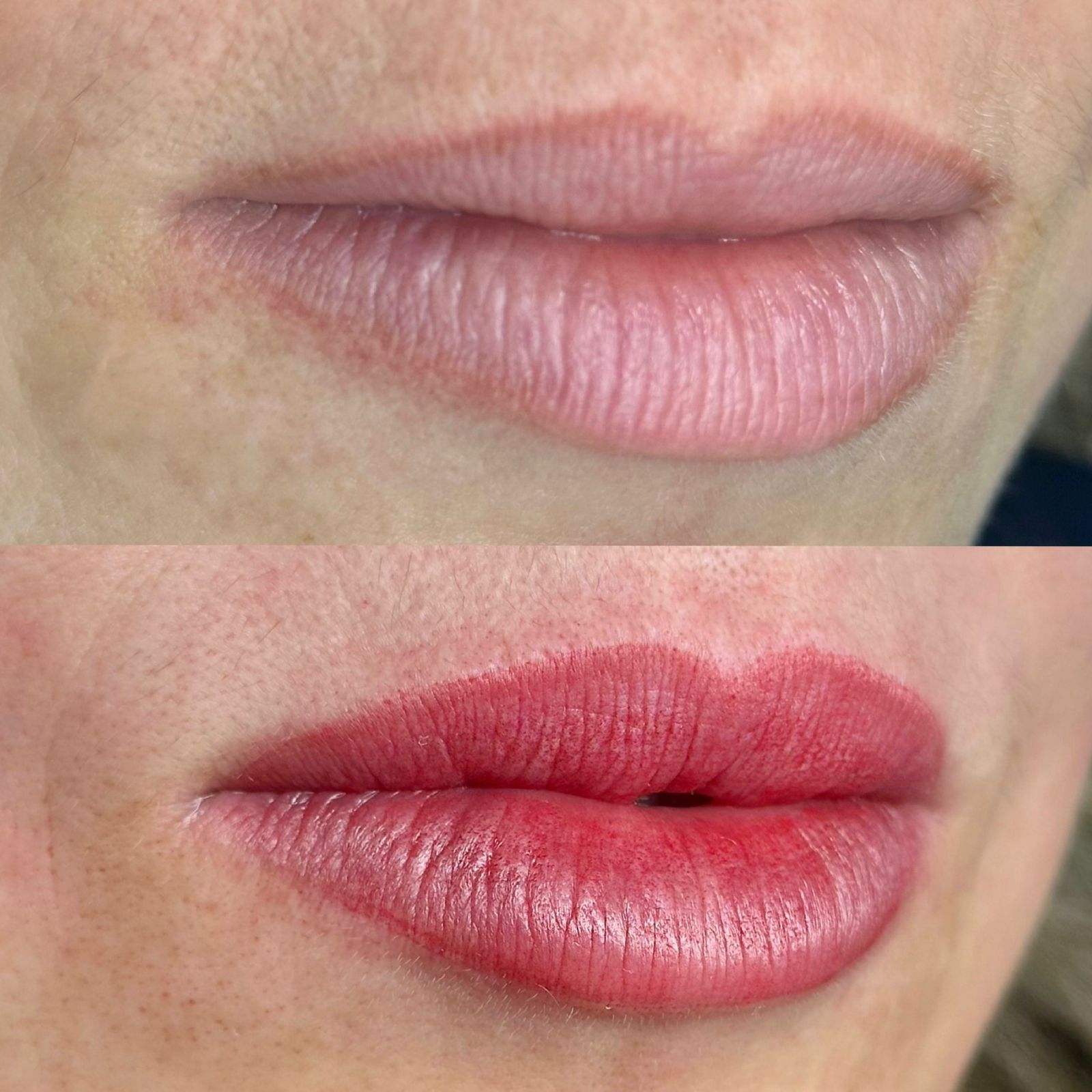 Revitalização labial — foto 3